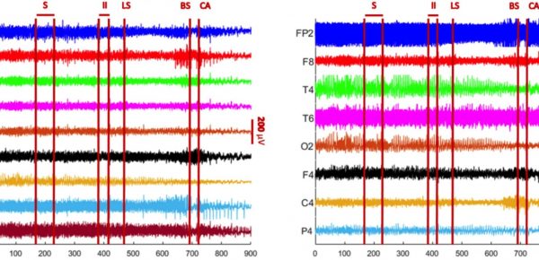 Impresionant – ce se întâmplă cu creierul nostru cu câteva minute înaintea morții