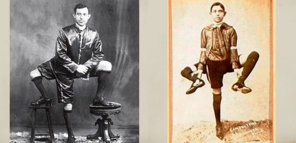 Povestea neștiută a omului cu trei picioare – Frank Lentini